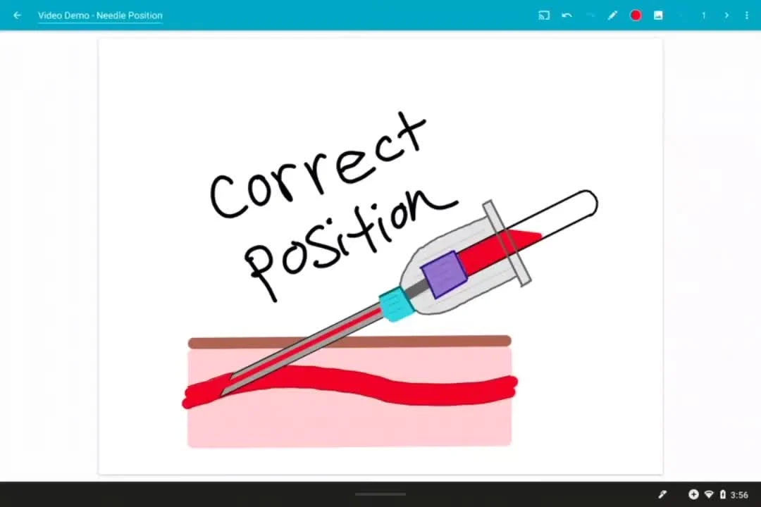 Diagram showing a needle inserted correctly into a vein.